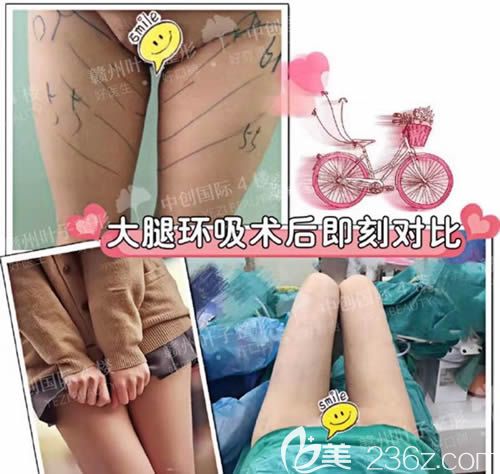 贛州葉子整形樂金堂吸脂瘦大腿案例效果對比圖 贛州葉子整形樂金堂吸脂瘦大腿案例效果對比圖