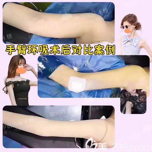 樂金堂吸脂瘦胳膊案例效果圖 樂金堂吸脂瘦胳膊案例效果圖