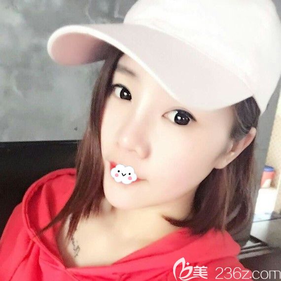 黃石中愛隆鼻效果怎么樣？萬文勇鼻綜合案例