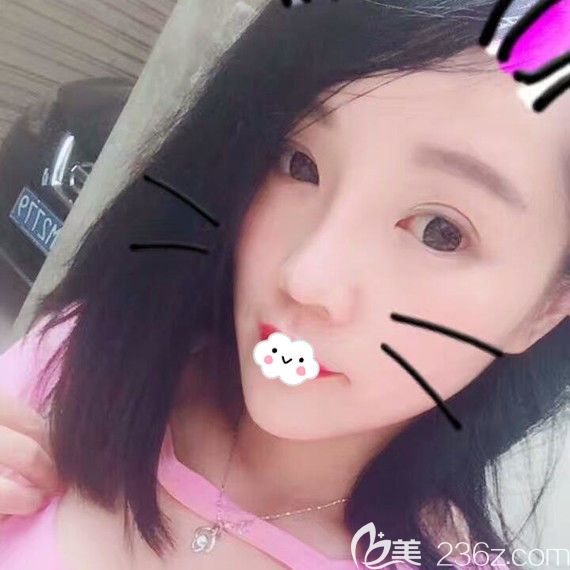 這是萬文勇做的鼻中隔軟骨隆鼻恢復(fù)圖,大家說黃石中愛隆鼻效果怎么樣?