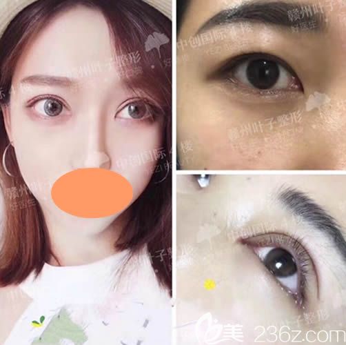 樂金堂眼綜合整形案例術(shù)后一個月效果圖 樂金堂眼綜合整形案例術(shù)后一個月效果圖