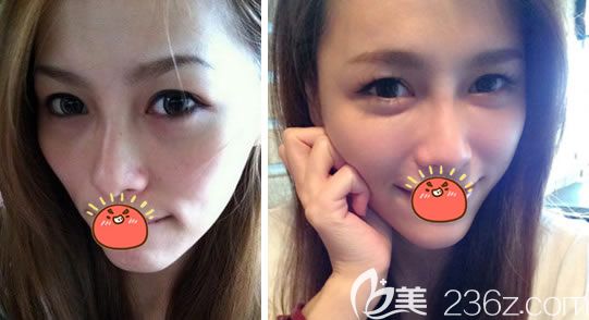 東陽麗萊莊軍達(dá)自體脂肪填充案例 東陽麗萊莊軍達(dá)自體脂肪填充案例