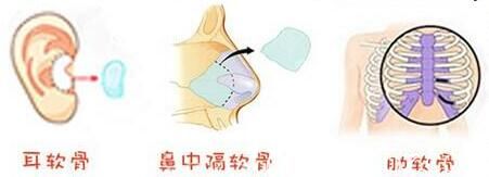 自體軟骨隆鼻