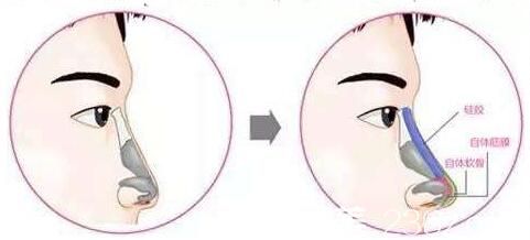 自體軟骨隆鼻和硅膠隆鼻那個(gè)更好？