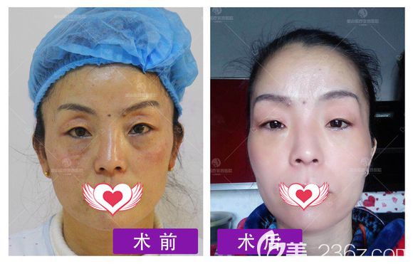 唐春香主任做祛眼袋手術(shù)案例 唐春香主任做祛眼袋手術(shù)案例