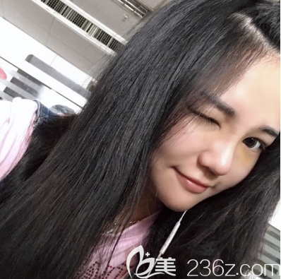 在廣州美恩做完隆鼻隆下巴10天效果圖 在廣州美恩做完隆鼻隆下巴10天效果圖