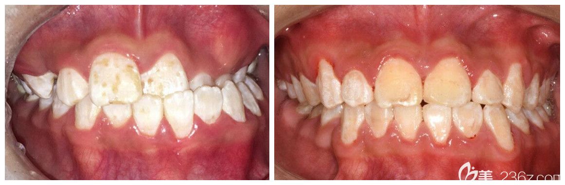 北京中諾口腔柯松林正畸案例 北京中諾口腔柯松林正畸案例