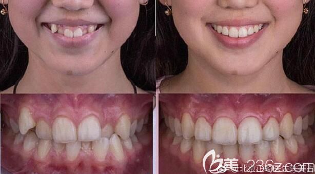 北京中諾口腔陳美占牙齒矯正案例 北京中諾口腔陳美占牙齒矯正案例