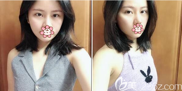 在成美豐胸術(shù)前胸前平坦 在成美豐胸術(shù)前胸前平坦