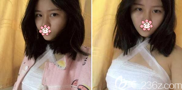 假體豐胸術(shù)后即刻效果 假體豐胸術(shù)后即刻效果