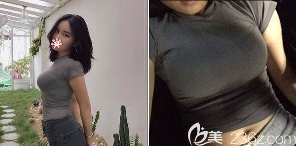 賴明忠豐胸手術(shù)術(shù)后一個月恢復(fù)效果 賴明忠豐胸手術(shù)術(shù)后一個月恢復(fù)效果