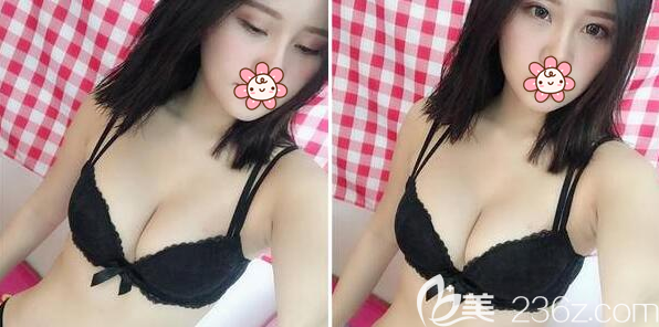 假體豐胸術(shù)后3個月內(nèi)衣照 假體豐胸術(shù)后3個月內(nèi)衣照