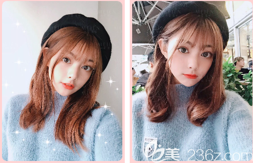 廣州美恩陳宏彬全臉脂肪填充3天照片 廣州美恩陳宏彬全臉脂肪填充3天照片