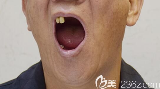 詹大爺去北京中諾口腔做種牙前的牙齒狀況 詹大爺去北京中諾口腔做種牙前的牙齒狀況