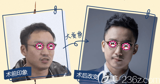 北京碧蓮盛發(fā)際線種植案例