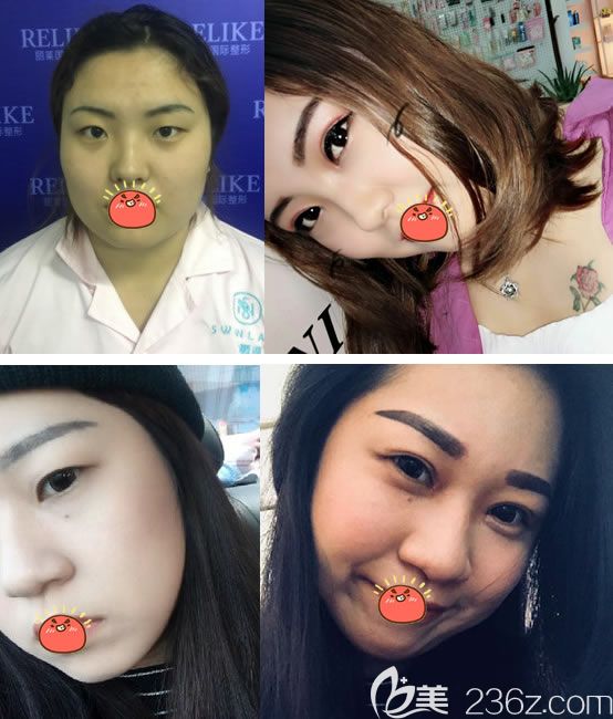 東陽橫店麗萊割雙眼皮案例