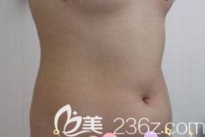 鄭州醫(yī)德佳找胡斌院長做腰腹吸脂前 鄭州醫(yī)德佳找胡斌院長做腰腹吸脂前