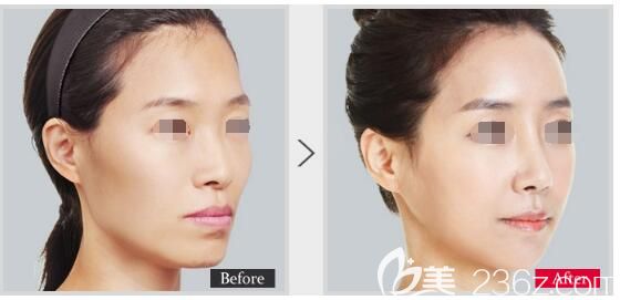 南京美貝爾3月優(yōu)惠活動(dòng)已開啟 5000元代金券項(xiàng)目包含眼鼻脂肪填充玻尿酸等多個(gè)項(xiàng)目