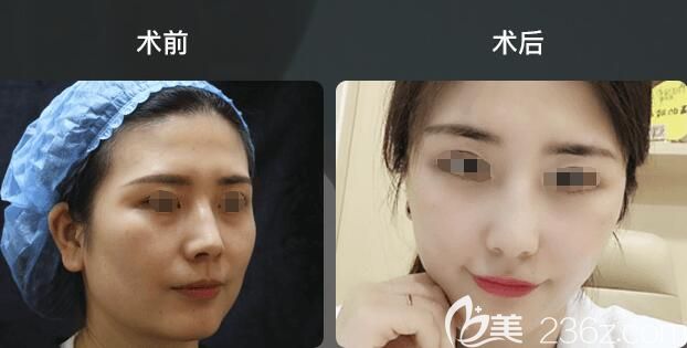 面部埋線提升案例對(duì)比照