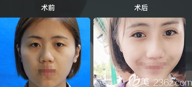 醫(yī)生雙眼皮整形前后對(duì)比案例