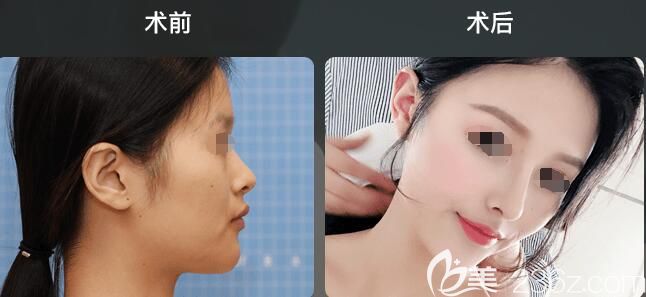 隆鼻前后對(duì)比案例