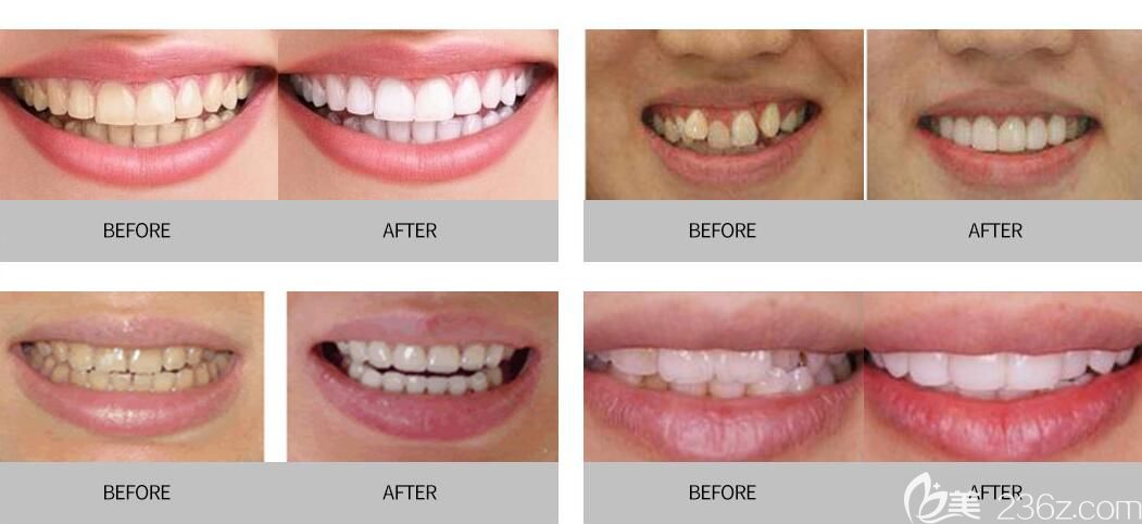 任艷醫(yī)生牙齒矯正案例對(duì)比照分享