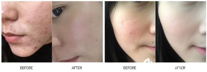 周林英激光美膚案例對(duì)比照 周林英激光美膚案例對(duì)比照