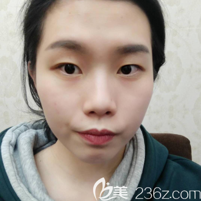 在廣州韓妃做雙眼皮的術(shù)前照片 在廣州韓妃做雙眼皮的術(shù)前照片