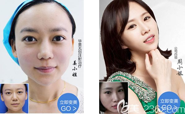 包頭華美醫(yī)療美容醫(yī)院注射玻尿酸和瘦臉除皺除皺案例