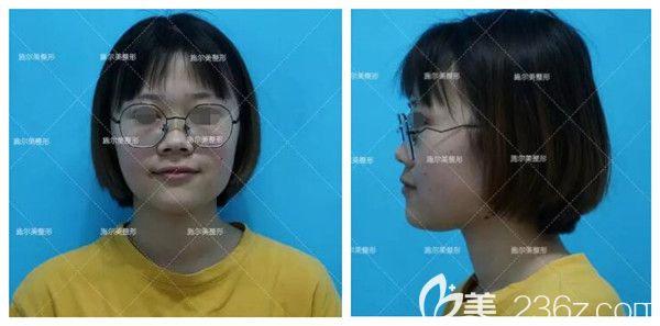 面診江蘇施爾美術(shù)前鼻子塌自卑 面診江蘇施爾美術(shù)前鼻子塌自卑