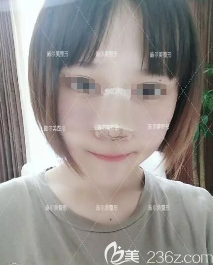 耳軟骨隆鼻術(shù)后一周恢復(fù)狀態(tài) 耳軟骨隆鼻術(shù)后一周恢復(fù)狀態(tài)