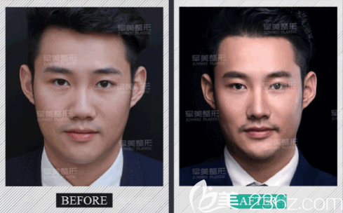 重慶軍美假體隆鼻案例