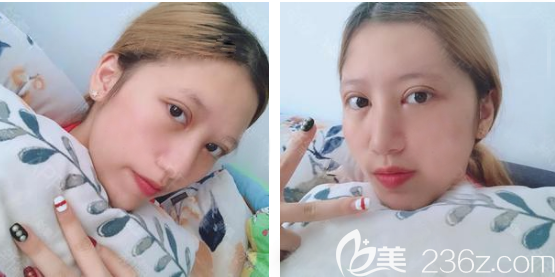 廣州韓妃王媛醫(yī)生雙眼皮案例9天圖片 廣州韓妃王媛醫(yī)生雙眼皮案例9天圖片