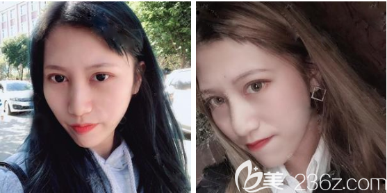 廣州韓妃王媛醫(yī)生雙眼皮術后兩個月圖片 廣州韓妃王媛醫(yī)生雙眼皮術后兩個月圖片