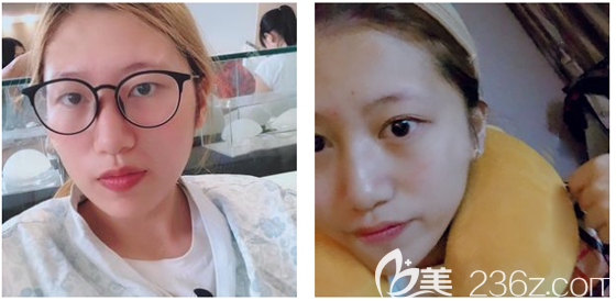 廣州韓妃雙眼皮術前照片 廣州韓妃雙眼皮術前照片