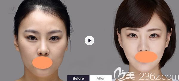 西寧康華醫(yī)院整形自體脂肪填充效果對(duì)比圖