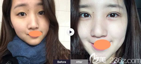 西寧康華醫(yī)院雙眼皮+開(kāi)眼角案例效果圖