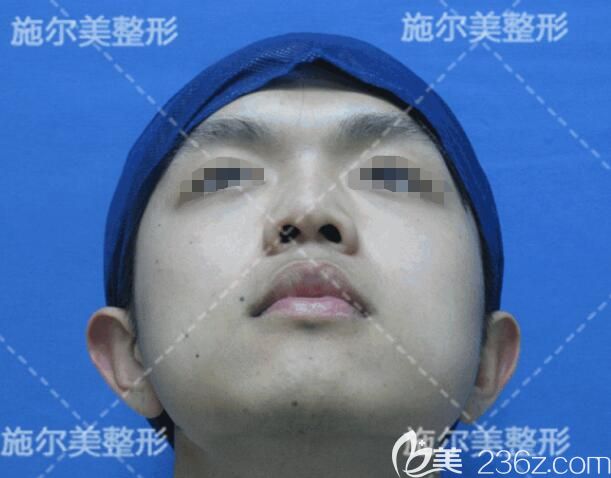 面診江蘇施爾美術(shù)前鼻子塌 面診江蘇施爾美術(shù)前鼻子塌