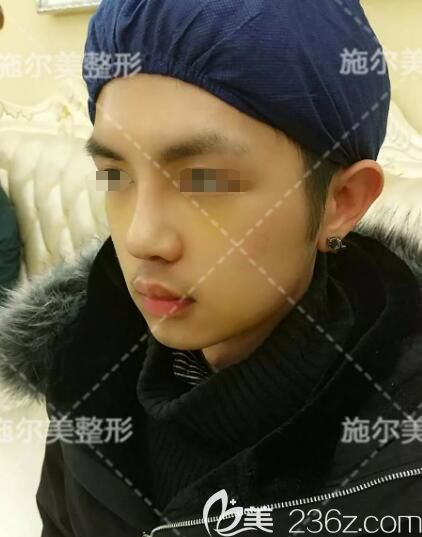 慕名找江蘇施爾美鼻整形醫(yī)生做自體肋軟骨+鼻翼縮小等get完美正側顏