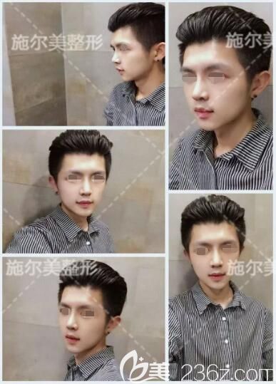 找江蘇施爾美醫(yī)生做肋軟骨隆鼻術(shù)后恢復(fù) 找江蘇施爾美醫(yī)生做肋軟骨隆鼻術(shù)后恢復(fù)