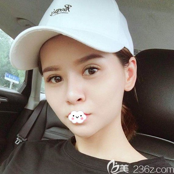 <!--<i data=20240703-sp></i>-->俞靜鼻綜合術(shù)后恢復(fù)效果