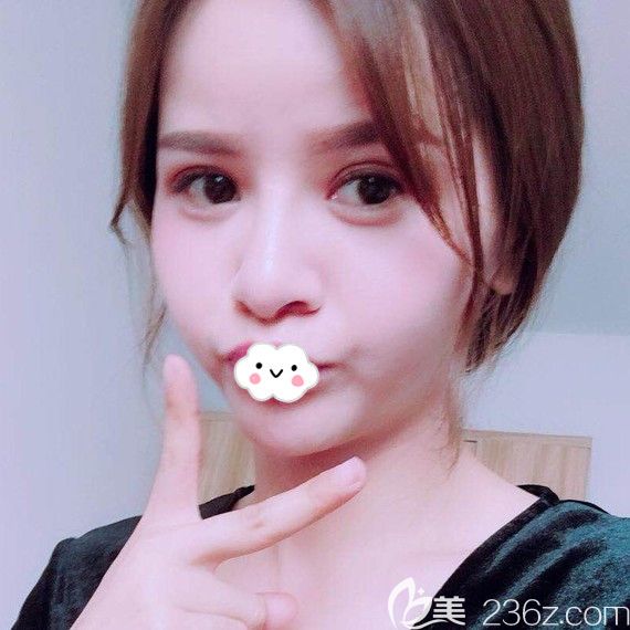 <!--<i data=20240703-sp></i>-->假體隆鼻綜合整形案例恢復(fù)效果圖