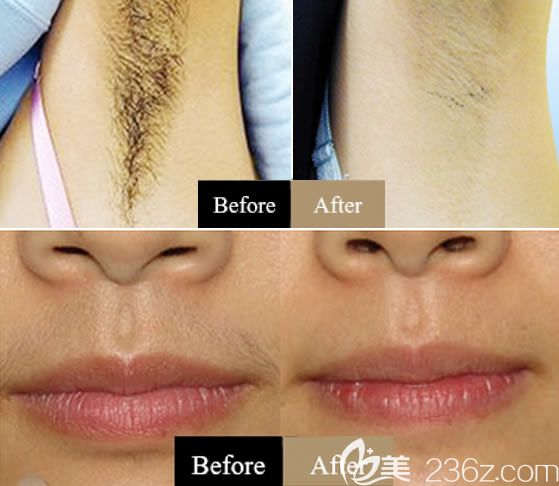 嘉興禾美整形激光脫毛案例