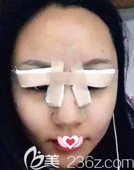 王興奎院長(zhǎng)為我剛做完眼綜合術(shù)后眼睛腫脹