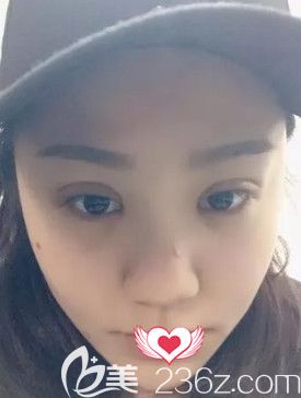 在石家莊藍(lán)山做眼綜合術(shù)后7天進(jìn)行拆線