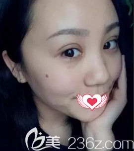 王興奎院長(zhǎng)做眼綜合術(shù)后15天眼睛消腫