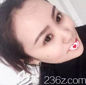 自從在石家莊藍(lán)山做完雙眼皮+開眼角手術(shù)后 再也不用羨慕人家的芭比大眼