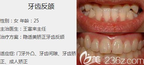 王富來主任正畸案例 王富來主任正畸案例