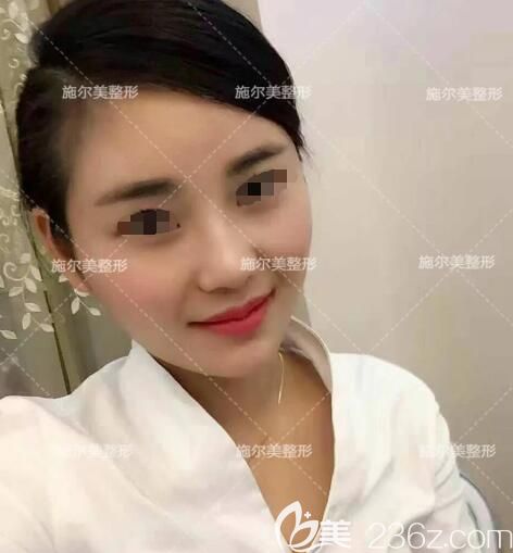 額頭痘痘密集、嘴角粉刺成堆的小姐姐到南京施爾美做了微針祛痘三次皮膚變好