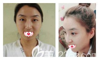 秦皇島巧致雙眼皮案例